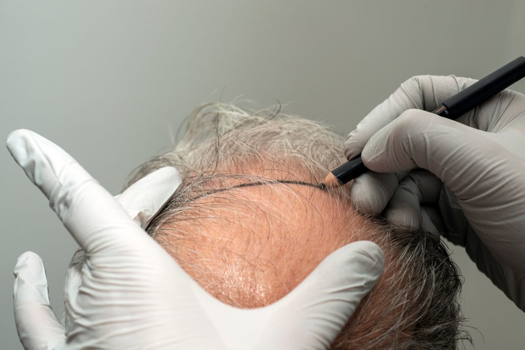 how much does a hair transplant cost in turkey